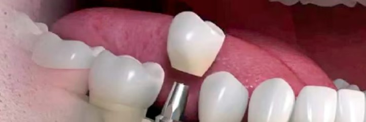 Implantologia dentale - Studio Froio